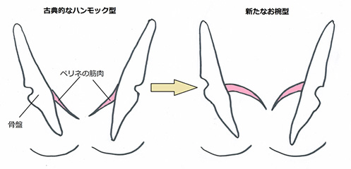 旧来のハンモック型と、新たに分かったお椀型のペリネ(骨盤底筋)