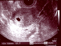 妊娠5週1日頃、GS8.6mm…1cmにも満たないちっちゃな胎嚢。