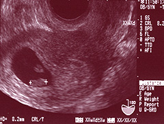 画像：妊娠6週4日頃、CRL(頭殿長)8.2mm。胎芽の上には卵黄嚢が。